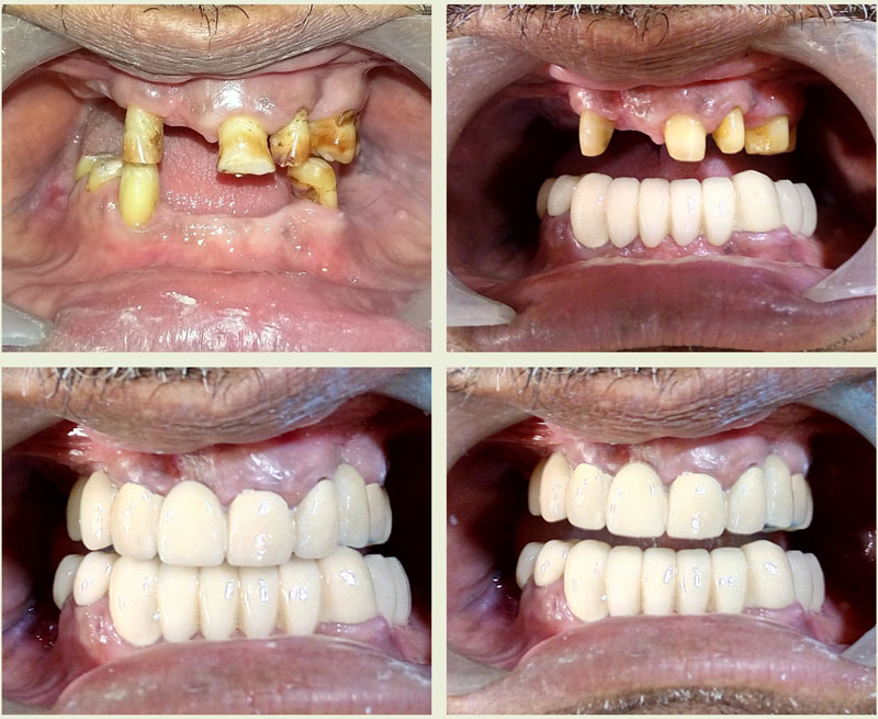 Some Of Our Cases | Arham Dental Clinic